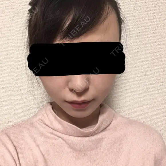 脂肪吸引（顔） / その他（輪郭） / 脂肪注入（輪郭） ヴィヴェンシアクリニック DAY 77 メイン用