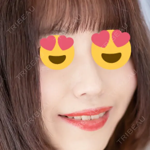 その他（鼻） ルラ美容クリニック 大宮院 / ルラスキンクリニック 大宮院 AFTER メイン用