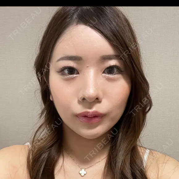 鼻尖形成（切開） / 鼻中隔延長（切開） / 小鼻縮小（切開） / 骨切幅寄せ / ワシ鼻修正・ハンプ切除 / 脂肪注入（額） Zetith Beauty Clinic 銀座院 DAY 172 メイン用
