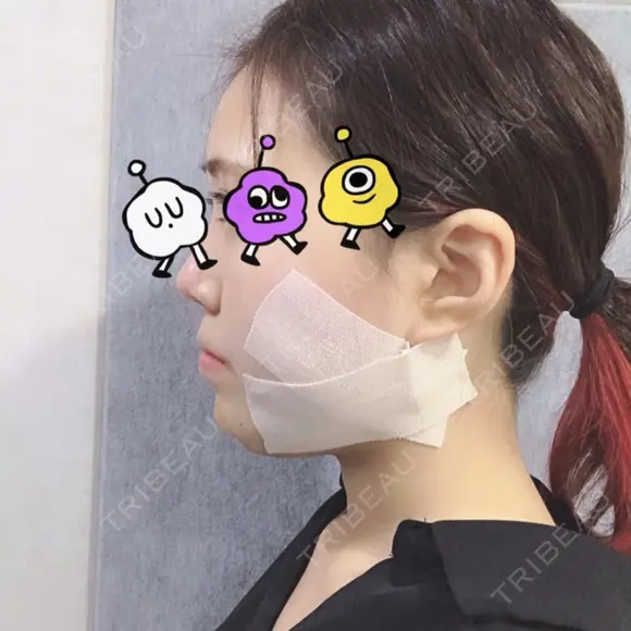 バッカルファット除去 / その他（輪郭） / ヒアルロン酸注入（あご） / ボトックス（エラ・小顔） エートップ美容整形外科 DAY 0 メイン用
