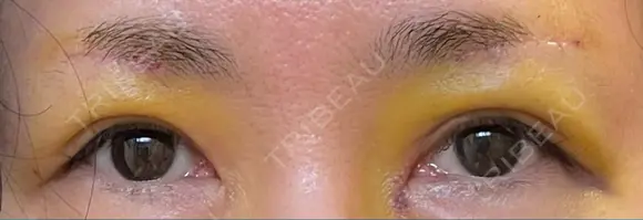 眉下切開 松下皮フ形成外科 DAY 5 メイン用