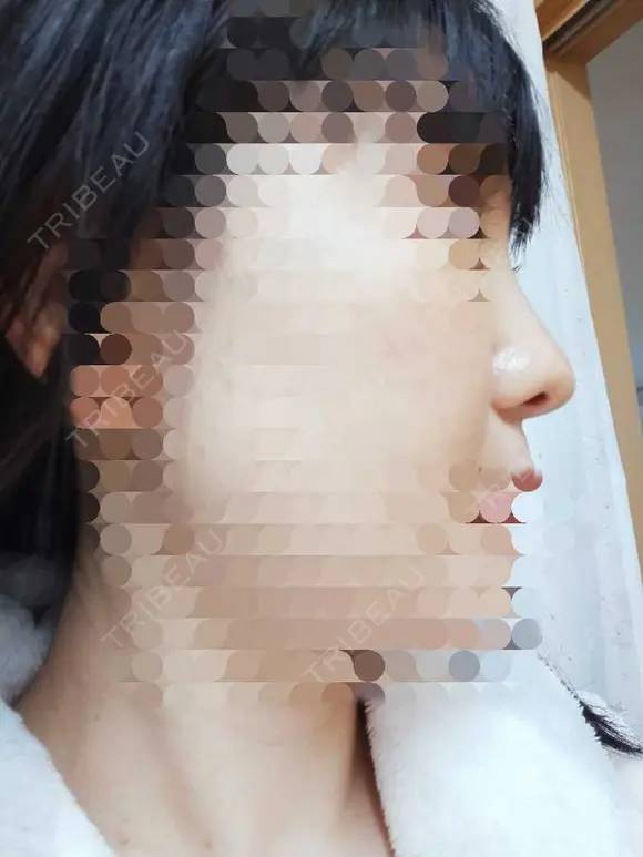 鼻尖形成（切開） / 鼻尖縮小 / ヒアルロン酸注入（鼻） 東京形成美容外科 船橋院 AFTER メイン用