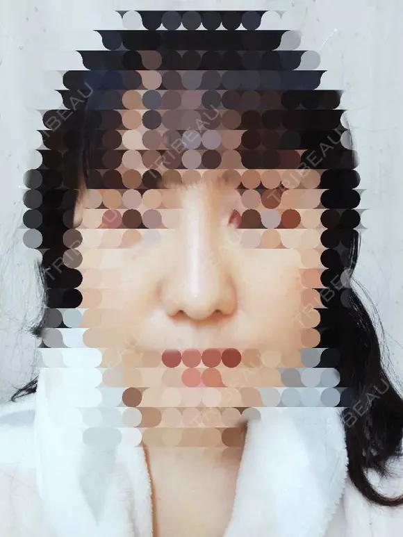 鼻尖形成（切開） / 鼻尖縮小 / ヒアルロン酸注入（鼻） 東京形成美容外科 船橋院 DAY 62 メイン用