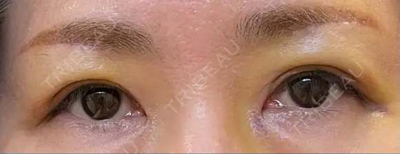 眉下切開 松下皮フ形成外科 DAY 6 メイン用