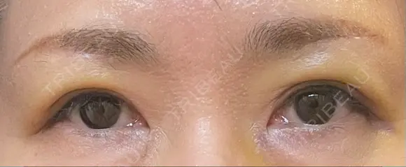 眉下切開 松下皮フ形成外科 DAY 7 メイン用