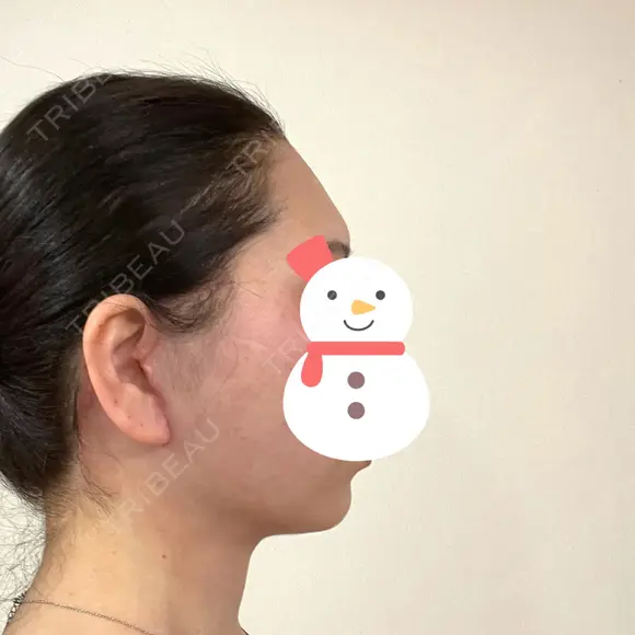 脂肪吸引（顔） / 切開リフト / PRP皮膚再生療法 湘南美容クリニック 新宿本院 DAY 61 メイン用