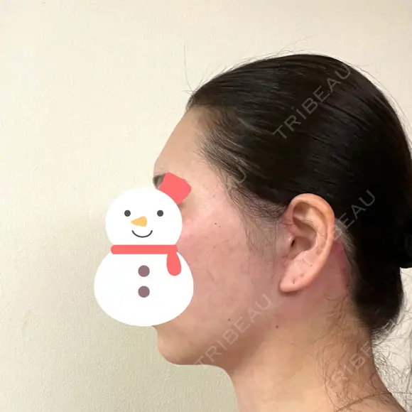 脂肪吸引（顔） / 切開リフト / PRP皮膚再生療法 湘南美容クリニック 新宿本院 DAY 61 メイン用