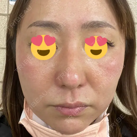 その他（肌） CHRISTINA CLINIC 銀座 DAY 0 メイン用