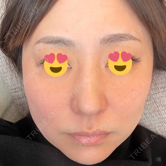 その他（肌） CHRISTINA CLINIC 銀座 DAY 1 メイン用