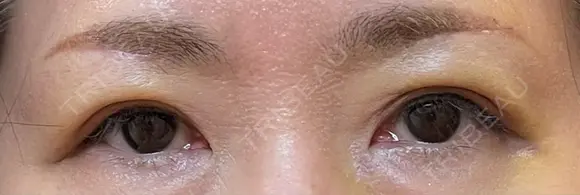 眉下切開 松下皮フ形成外科 DAY 8 メイン用