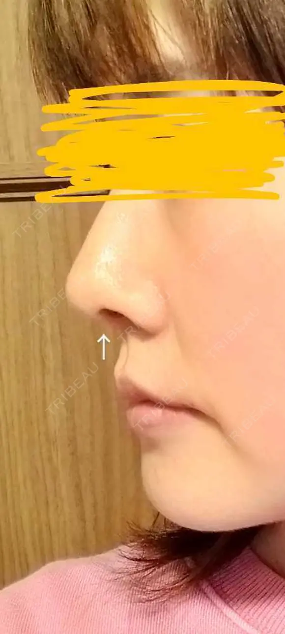 軟骨移植 LIKI CLINIC KOBE AFTER メイン用