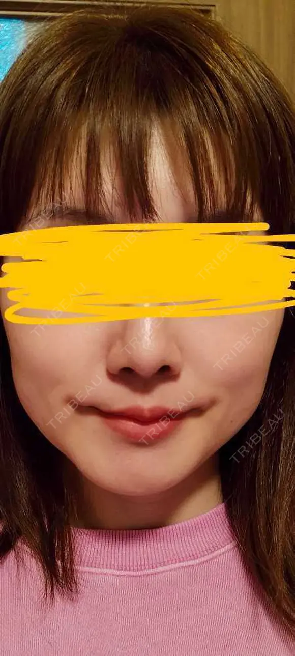 軟骨移植 LIKI CLINIC KOBE DAY 57 メイン用