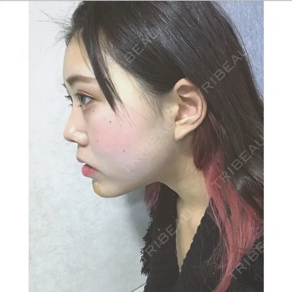 バッカルファット除去 / その他（輪郭） / ヒアルロン酸注入（あご） / ボトックス（エラ・小顔） エートップ美容整形外科 DAY 1 メイン用