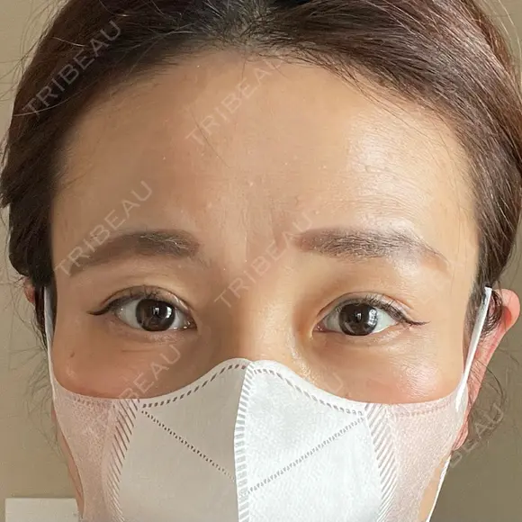 二重切開 / 眼瞼下垂（切開） 湘南美容クリニック Regno 銀座院 DAY 37 メイン用