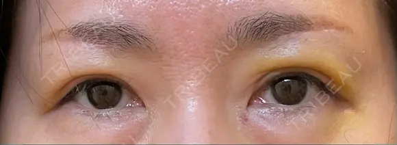 眉下切開 松下皮フ形成外科 DAY 10 メイン用