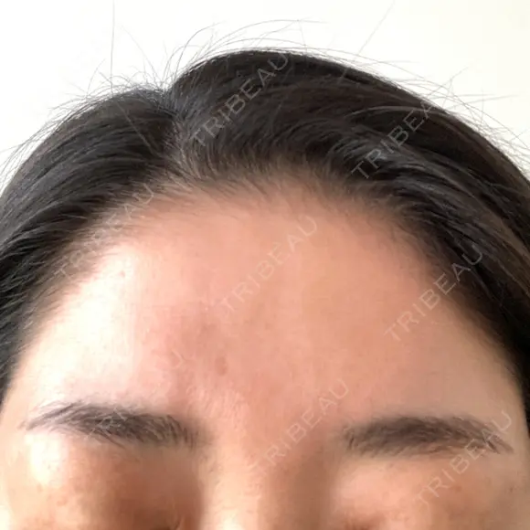 アートメイク（眉） AIM Beauty Medical Clinic DAY 8 メイン用