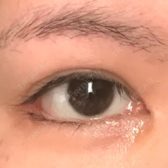 目頭切開 / 目尻切開 / 目尻靭帯移動 FROM B整形外科 (旧バウム整形外科) DAY 44 メイン用