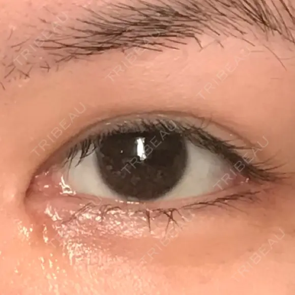 目頭切開 / 目尻切開 / 目尻靭帯移動 FROM B整形外科 (旧バウム整形外科) DAY 44 メイン用