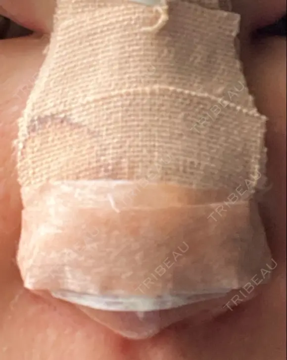 隆鼻術 / 鼻尖形成（切開） / 軟骨移植 白山クリニック 大分 DAY 1 メイン用