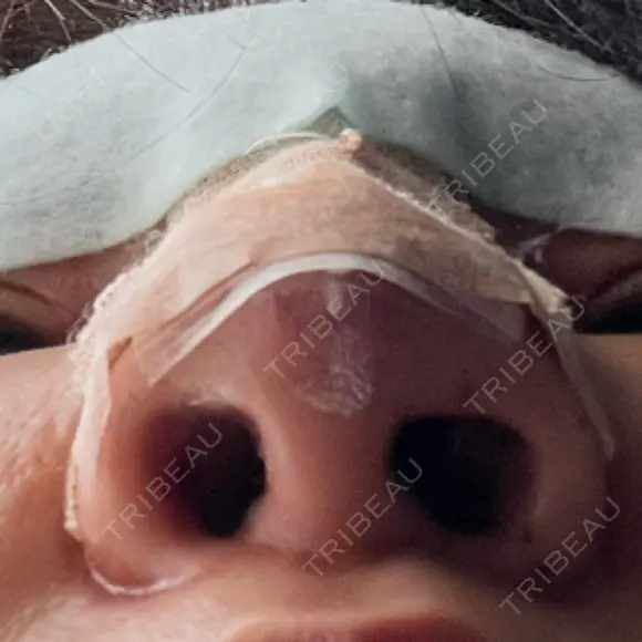 隆鼻術 / 鼻尖形成（切開） / 軟骨移植 白山クリニック 大分 DAY 1 メイン用