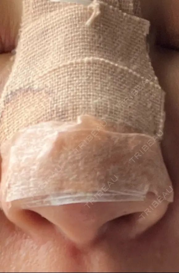 隆鼻術 / 鼻尖形成（切開） / 軟骨移植 白山クリニック 大分 DAY 2 メイン用