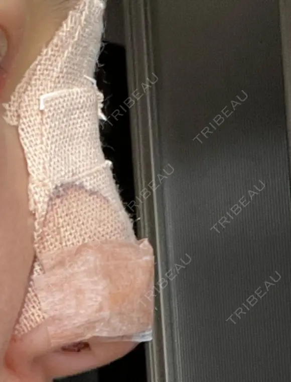 隆鼻術 / 鼻尖形成（切開） / 軟骨移植 白山クリニック 大分 DAY 2 メイン用