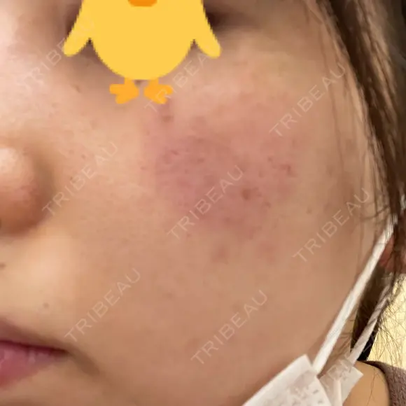 レーザートーニング（美白・肝斑） 渋谷美容外科クリニック 池袋院 AFTER メイン用