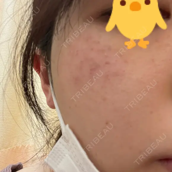 レーザートーニング（美白・肝斑） 渋谷美容外科クリニック 池袋院 DAY 28 メイン用