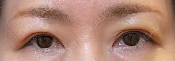 眉下切開 松下皮フ形成外科 DAY 12 メイン用