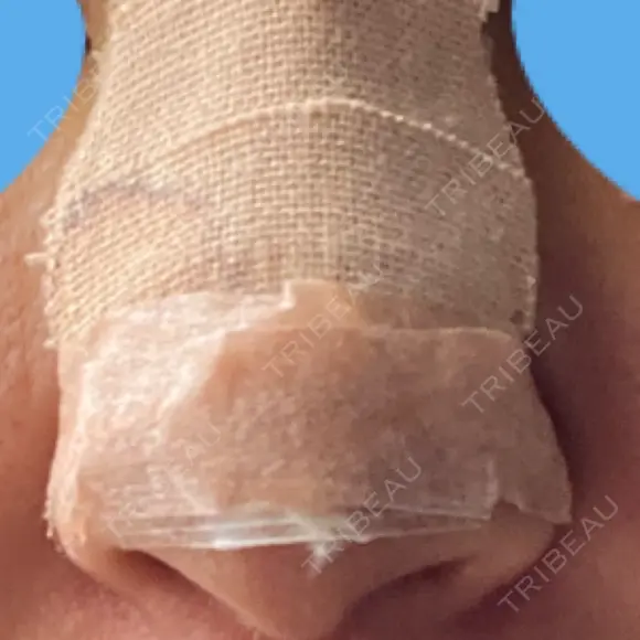 隆鼻術 / 鼻尖形成（切開） / 軟骨移植 白山クリニック 大分 DAY 3 メイン用