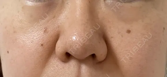 ピコスポット The Natural Beauty Clinic 麻布十番院 DAY 3 メイン用