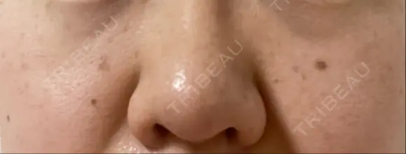 ピコスポット The Natural Beauty Clinic 麻布十番院 DAY 3 メイン用