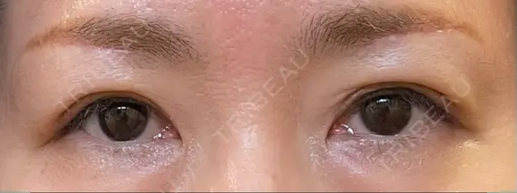 眉下切開 松下皮フ形成外科 DAY 14 メイン用