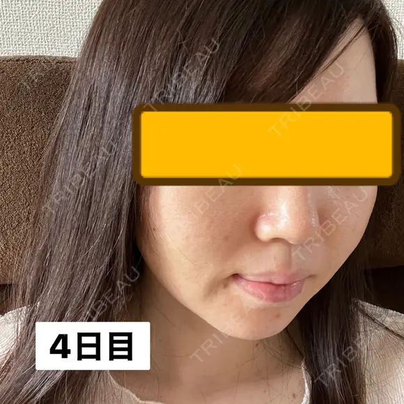 糸リフト / ヒアルロン酸注入（頬） EMMA CLINIC（エマクリニック） DAY 4 メイン用