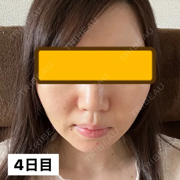 糸リフト / ヒアルロン酸注入（頬） EMMA CLINIC（エマクリニック） DAY 4 メイン用