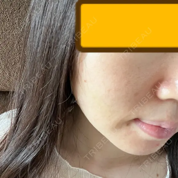 糸リフト / ヒアルロン酸注入（頬） EMMA CLINIC（エマクリニック） DAY 4 メイン用