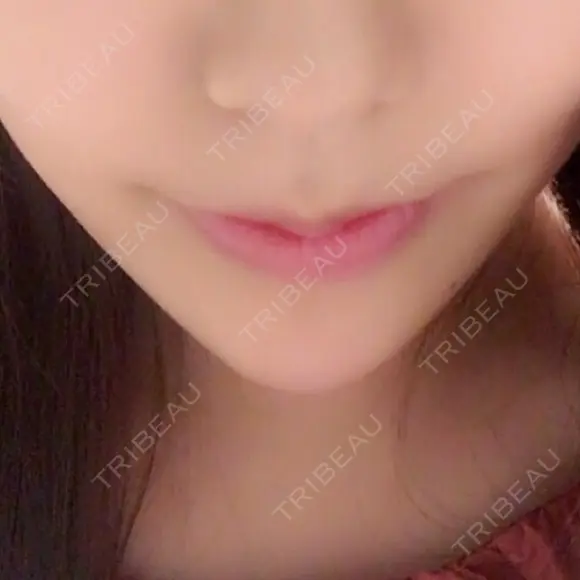 ヒアルロン酸注入（あご） / ボトックス（エラ・小顔） / 脂肪溶解注射（顔） 品川スキンクリニック神戸院（※品川美容外科提携） DAY 14 メイン用