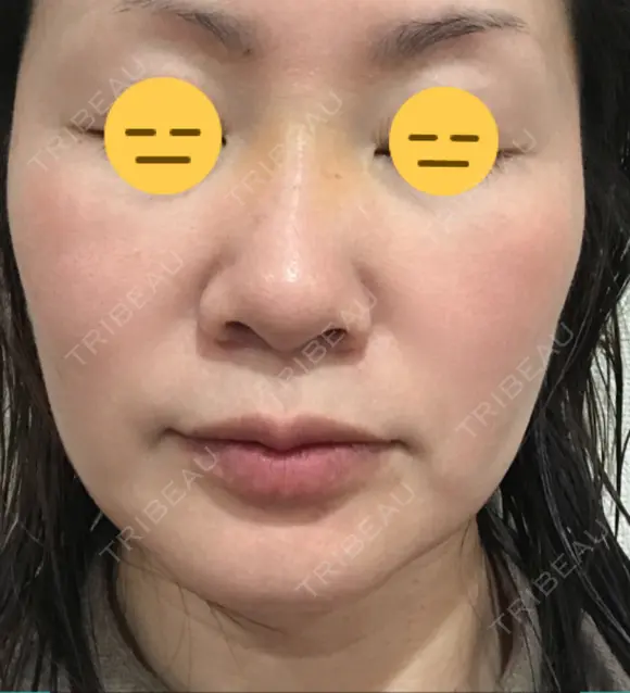 糸リフト / 脂肪吸引（顔） / ボトックス（エラ・小顔） 銀座マイアミ美容外科 AFTER メイン用