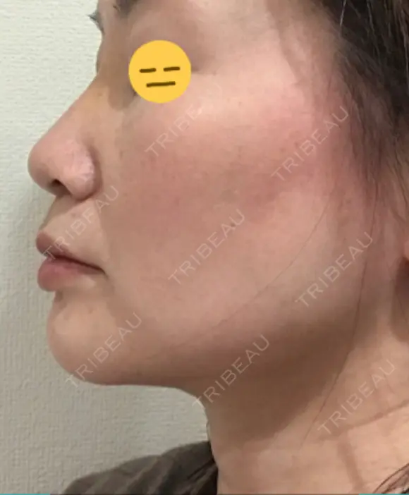 糸リフト / 脂肪吸引（顔） / ボトックス（エラ・小顔） 銀座マイアミ美容外科 DAY 26 メイン用