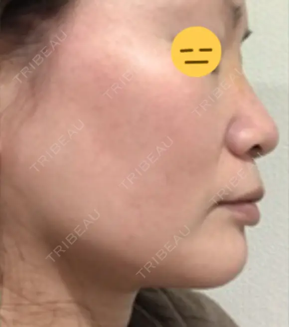 糸リフト / 脂肪吸引（顔） / ボトックス（エラ・小顔） 銀座マイアミ美容外科 DAY 26 メイン用