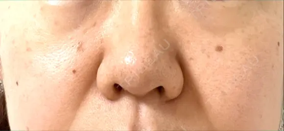 ピコスポット The Natural Beauty Clinic 麻布十番院 DAY 3 メイン用