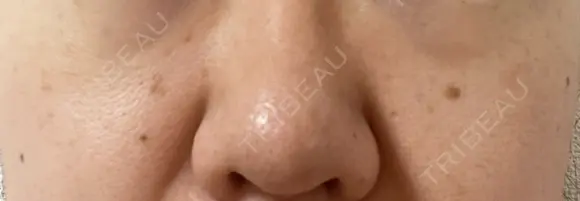 ピコスポット The Natural Beauty Clinic 麻布十番院 DAY 5 メイン用