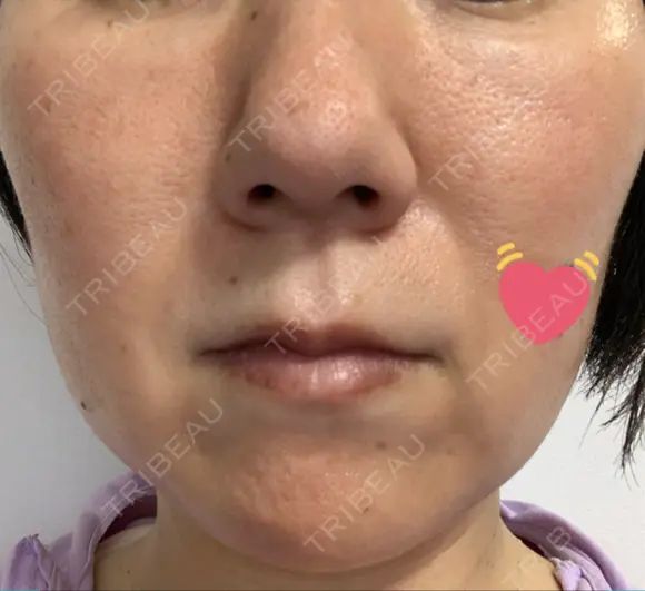 ハイフ（顔） 湘南美容クリニック 大阪京橋院 DAY 26 メイン用