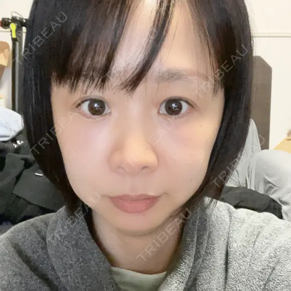 PRP皮膚再生療法 閉院｜プルージュ美容クリニック 赤羽院 DAY 1 メイン用
