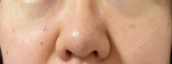 ピコスポット The Natural Beauty Clinic 麻布十番院 DAY 7 メイン用