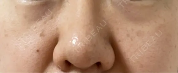 ピコスポット The Natural Beauty Clinic 麻布十番院 DAY 9 メイン用