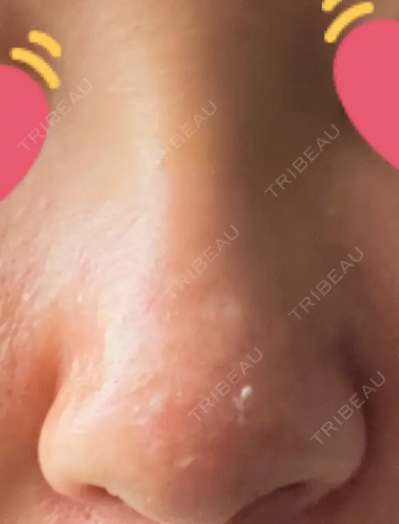 隆鼻術 / 鼻尖形成（切開） / 軟骨移植 白山クリニック 大分 AFTER メイン用