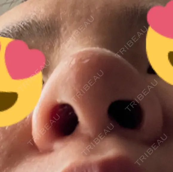 隆鼻術 / 鼻尖形成（切開） / 軟骨移植 白山クリニック 大分 DAY 9 メイン用