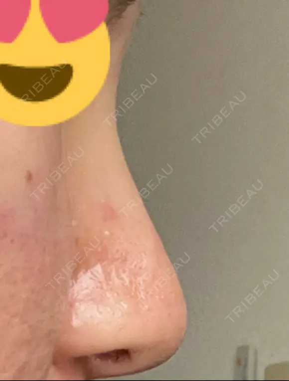 隆鼻術 / 鼻尖形成（切開） / 軟骨移植 白山クリニック 大分 DAY 9 メイン用