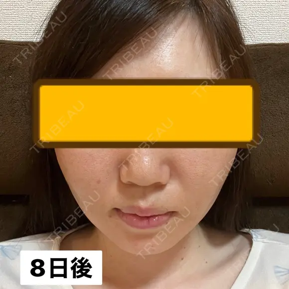 糸リフト / ヒアルロン酸注入（頬） EMMA CLINIC（エマクリニック） DAY 8 メイン用